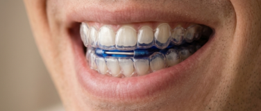 Aparelho intraoral utilizado no tratamento do ronco e da apneia obstrutiva do sono.